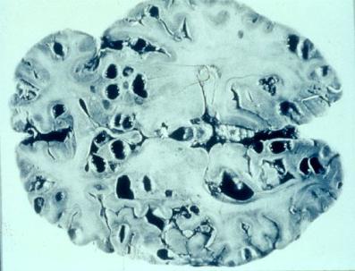 Cysticercosis גורם תסמינים וטיפול