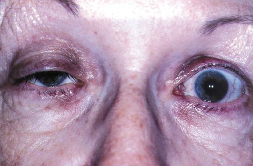 myasthenia gravis מה זה? 