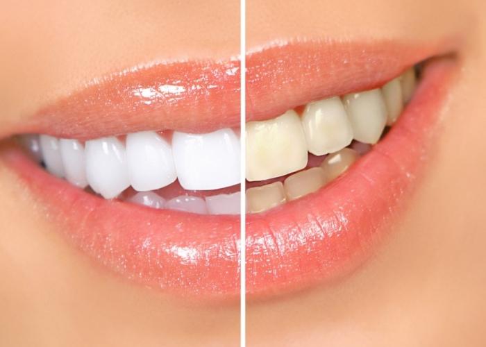 דרך בלתי רגילה להשתמש מי חמצן: הלבנת שיניים
