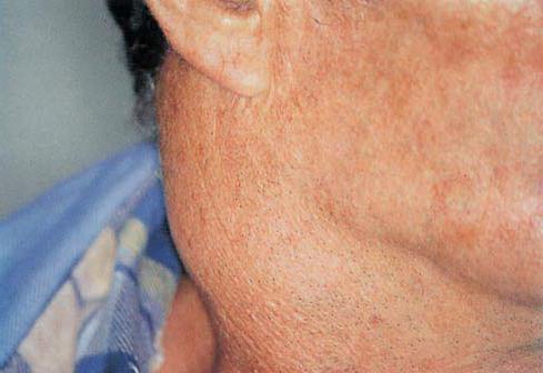 גורם ותסמינים של דלקת בלוטות הלימפה על הצוואר