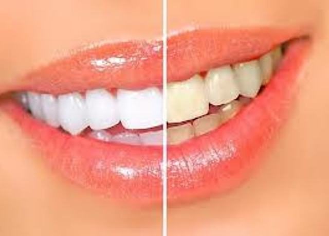 הלבנה עצמית של השיניים עם מי חמצן.